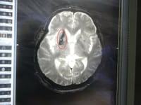 今日はMRI検査/脳内出血跡