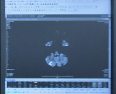 新脳梗塞箇所再検MRI　　　　　20230817